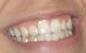 Tooth
